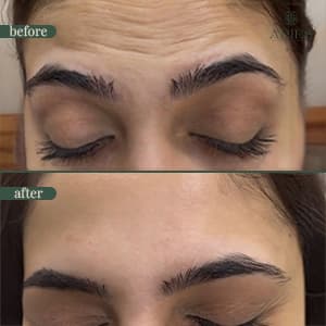Anti-wrinkle injection before and after result 1