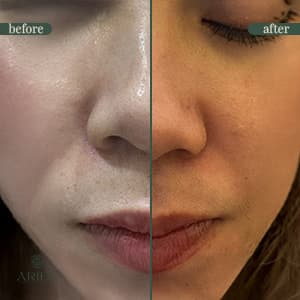 Anti-wrinkle injection before and after result 2