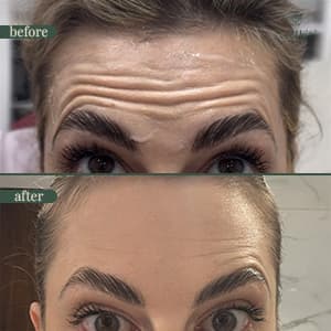 Anti-wrinkle injection before and after result 3