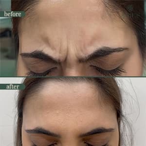 Anti-wrinkle injection before and after result 4